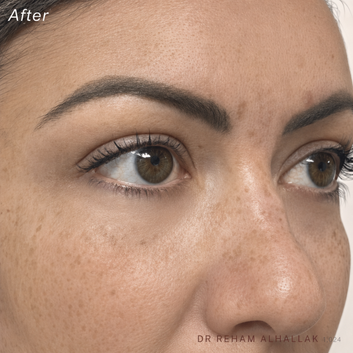 After treatment